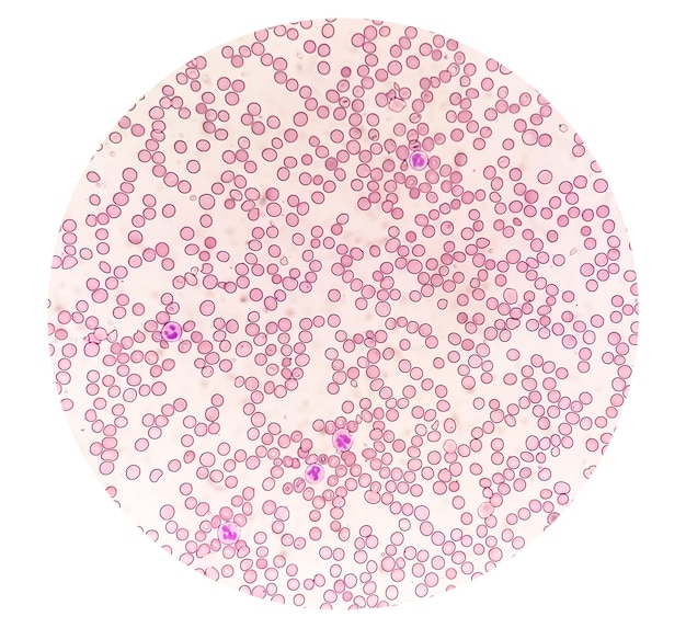 Foto fotomicrógrafo suggestivo de anemia megaloblástica para descartar la anemia perniciosa