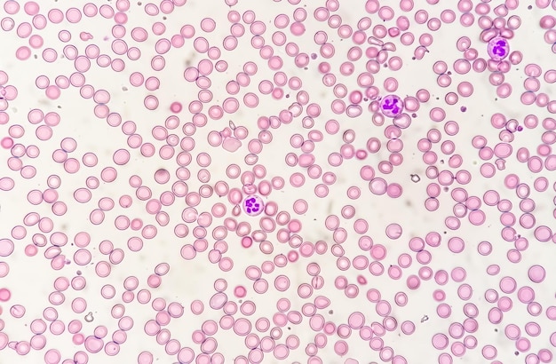 Fotomicrógrafo Suggestivo de anemia megaloblástica para descartar la anemia perniciosa
