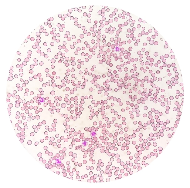 Fotomikrograph Suggestive von megaloblastischer Anämie, um perniciöse Anämie auszuschließen