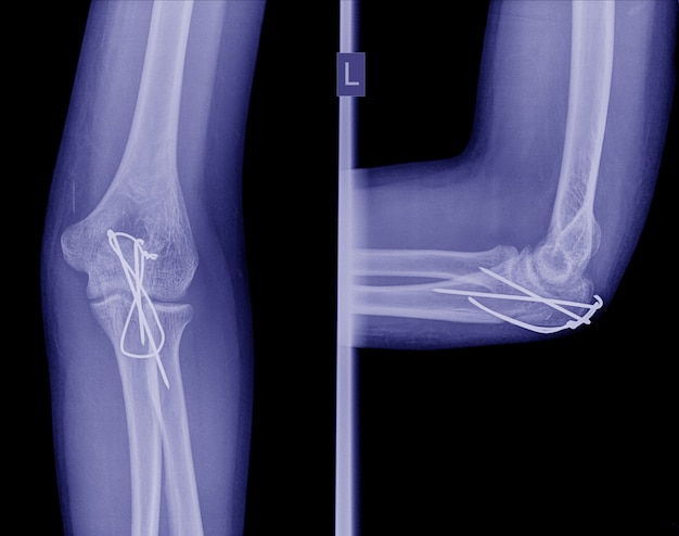 Foto fractura de codo de fijación interna de operación de rayos x