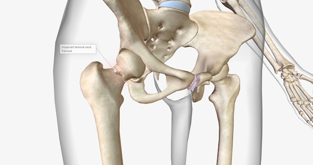 Foto una fractura de cuello femoral es un tipo de fractura de cadera que ocurre en la sección del fémur más cercana a la pelvis.