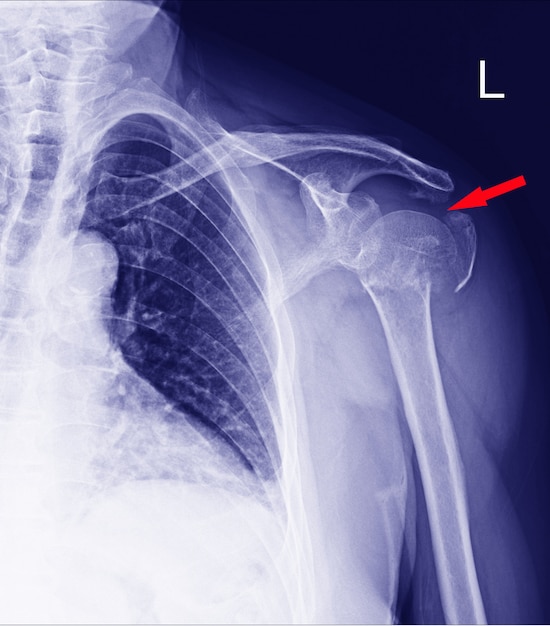 Fractura del cuello húmero.