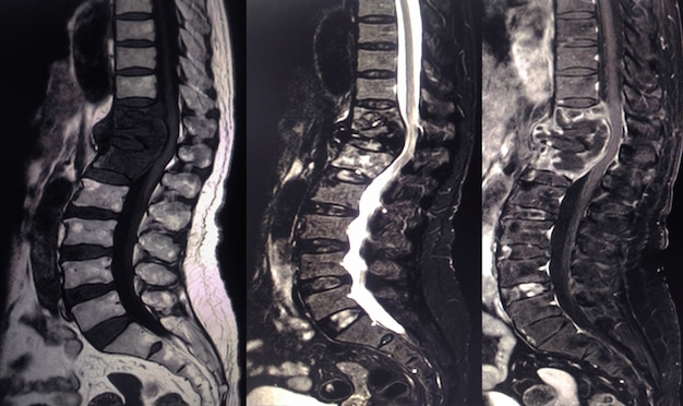 Foto fractura de t12 con destrucción ósea de t11 y l1.