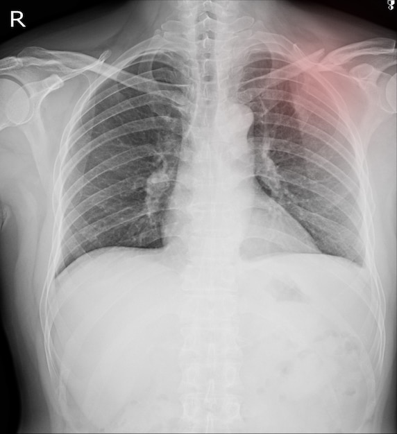 Fracturas de rayos X del tórax Clavícula izquierda, costilla 2da anterior, costilla posterior 4,5.