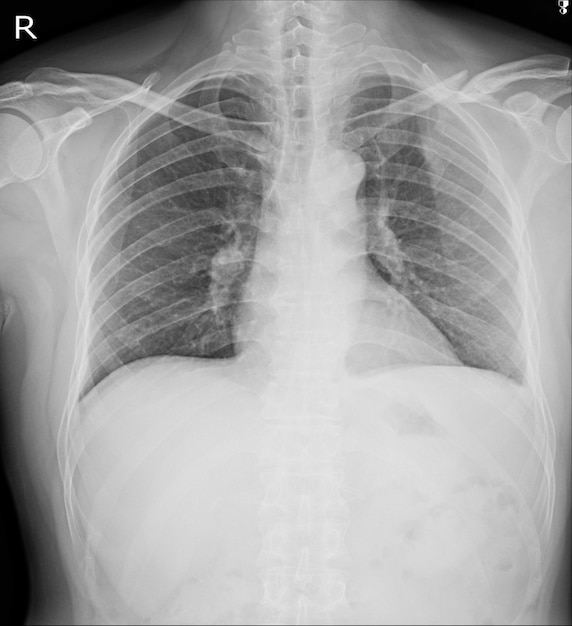 Foto fracturas de rayos x del tórax clavícula izquierda, costilla 2da anterior, costilla posterior 4,5.