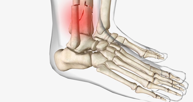 Foto las fracturas de tibia distal afectan la articulación del tobillo y, a menudo, pueden implicar una fractura del peroné.