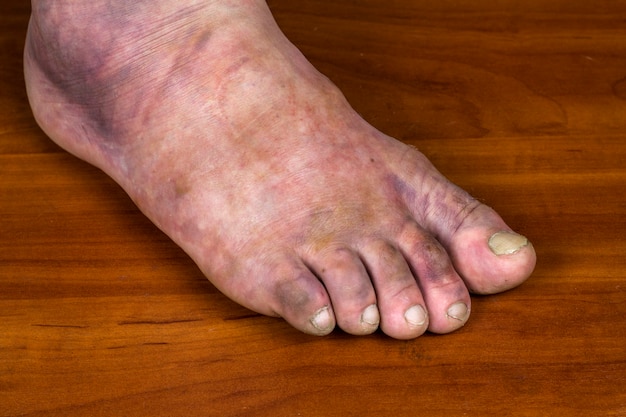 Fratura de pé humano. Um enorme hematoma roxo na perna de um homem.