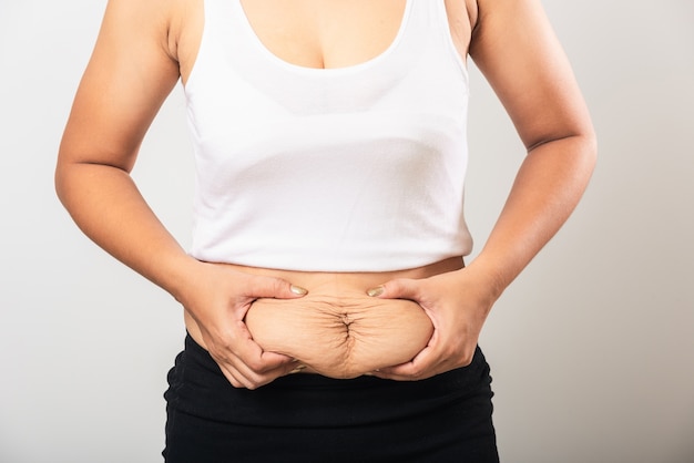 Frau, die Dehnungsstreifen auf Bauch zeigt