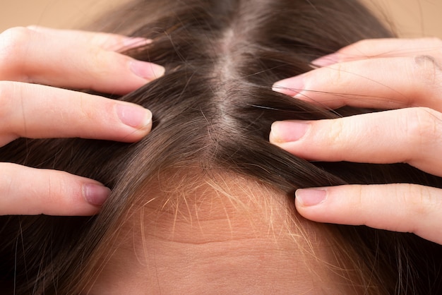 Frau mit Haarausfallproblem. Porträt des jungen Mädchens mit einer Glatze. Kopfschuss eines nervösen Mädchens mit einer Haarbürste.