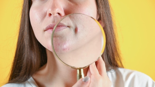 Frau mit Lupe von Gesicht beschnitten Ansicht Nahaufnahme von großen Pickel Kosmetologie Hautpflege Aknebehandlung