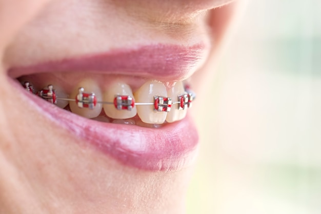 Frauenlächeln zeigt ihre Zähne mit Zahnspangen. Zahnarzt- und Kieferorthopädiekonzept