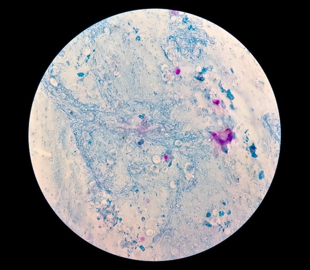 Frotis de esputo bajo microscopía que muestra cocos grampositivos