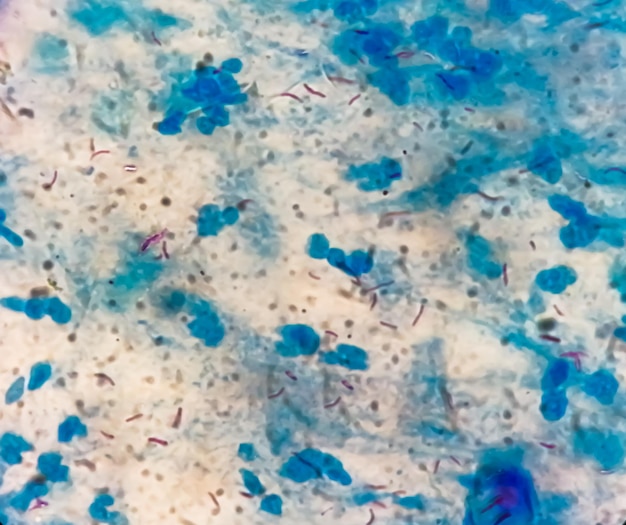 Frotis de esputo o flema AFB tinción bajo microscopía que muestra la bacteria Macrobacterium Tuberculosis (MTB)
