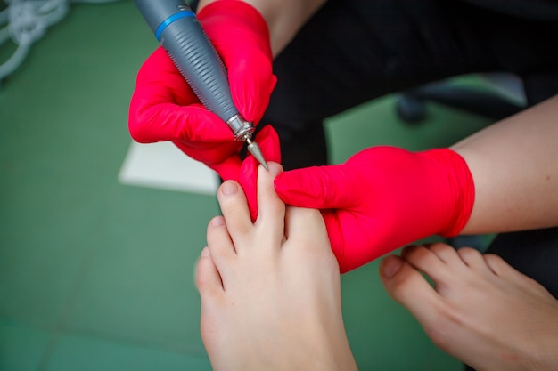 Fußarzt, der Zehennagelpilz behandelt. Podologische Behandlung.