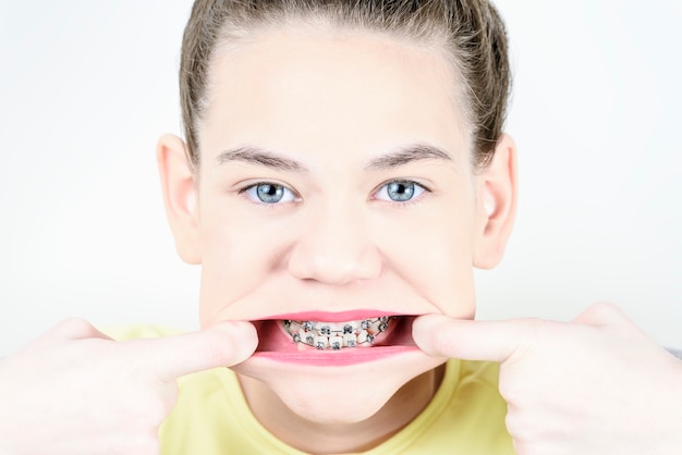 Garota mostra aparelho dentário, esticando a boca com os dedos.