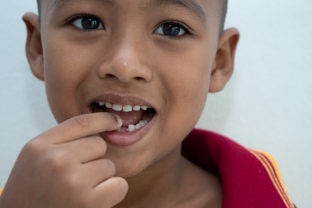 Garotinho sorrindo com dentes quebrados