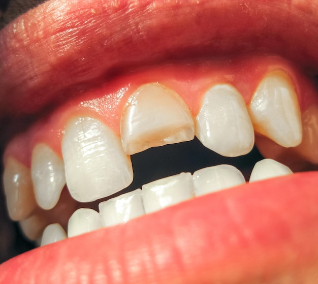 Gebrochener Zahn, gebrochener oberer Schneidzahn in einem Mannsmund