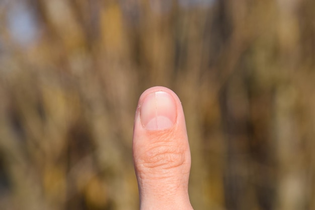 Foto gegabelter nagel am daumen dilatation des nagels traumatische pathologie der nagel ist in zwei hälften geteilt