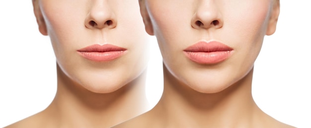 Foto gente, cosmetología, cirugía plástica y concepto de belleza - hermosa mujer joven cara mujer antes y después de aumento de labios sobre fondo blanco
