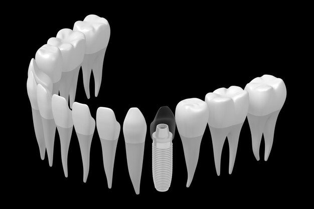 Foto gesundheitszähne und ein implantat isoliert auf weißem hintergrund 3d-illustration