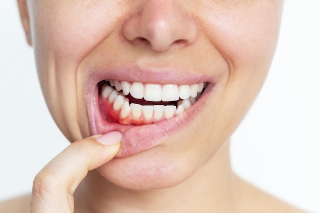 Gingivitis inflamación de las encías Mujer joven con hemorragias rojas de encías
