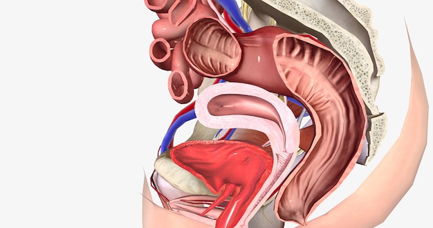 El grado 3 describe un cistocele en el que el bulto pasa el nivel del himen y está a mitad de camino fuera de la abertura vaginal.