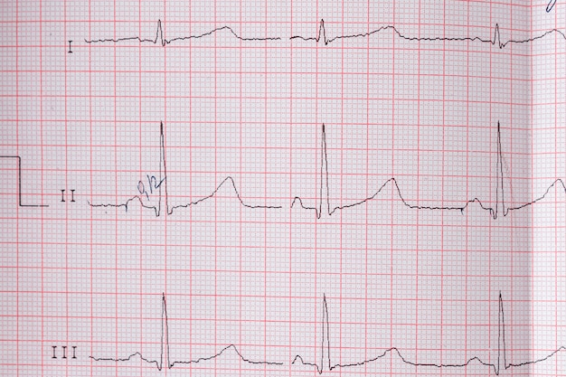 Gráfico de eletrocardiograma do coração EKG em papel especial. Conceito de tomografia cardíaca, seguro saúde, antecedentes médicos, exames.