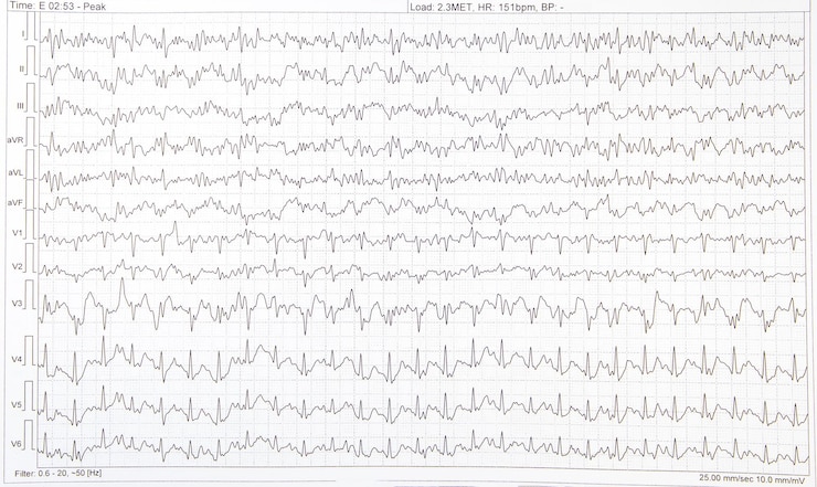 Foto grafisches ekg-elektrokardiogramm einer person mit herzkrankheit
