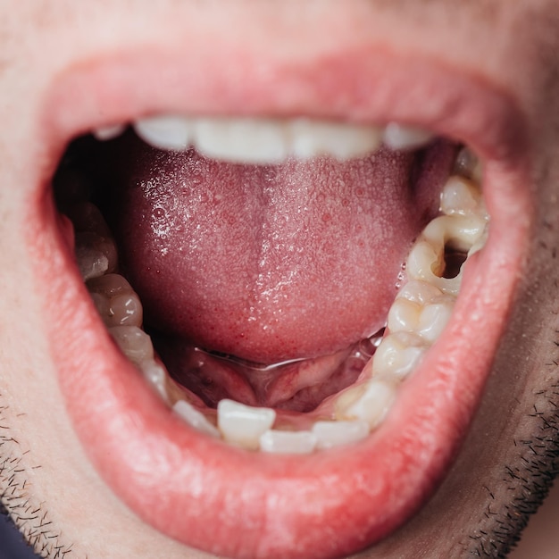 Foto gran agujero en el diente de mascar perforado por el dentista para el tratamiento