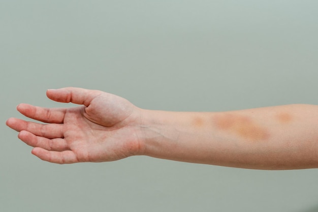 Gran hematoma en el brazo de la mujer aislado sobre fondo blanco.