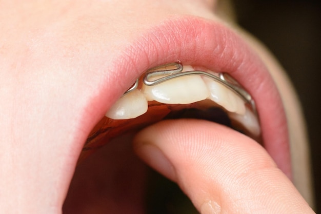 Un gran plan para vestir una placa de metal para erizarse los dientes.