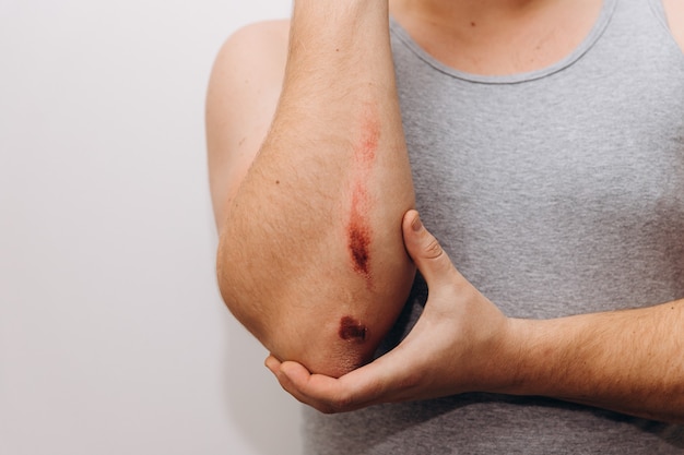 Grandes abrasiones en el antebrazo de un hombre tras una caída. El hombre le sostiene el codo con la mano.