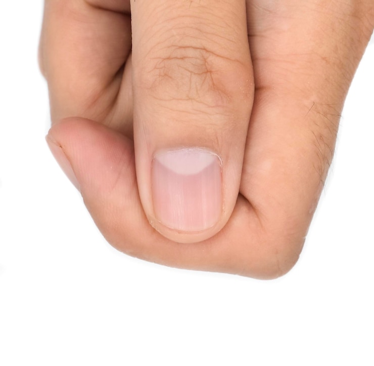 Foto grandes lúnulas ou meia-lua na unha do polegar com linhas longitudinais do jovem do sudeste asiático isolado no branco