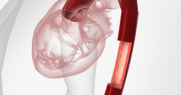 Grandes volúmenes de linfocitos, macrófagos y otras células inmunitarias se infiltran en la aorta inflamada.