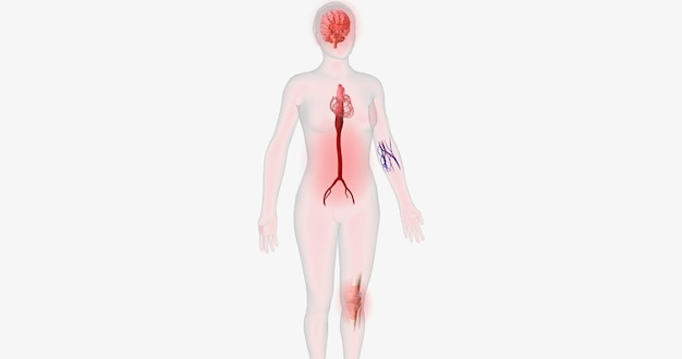 Grandes volumes de células imunes se infiltram na aorta inflamada