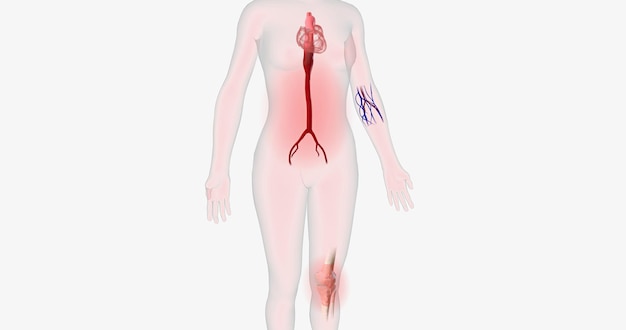 Grandes volumes de células imunes se infiltram na aorta inflamada