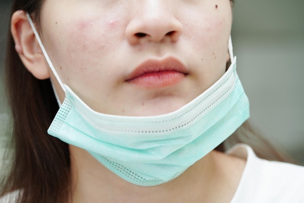Grano de acné y cicatriz en la piel trastornos de la cara de las glándulas sebáceas adolescente cuidado de la piel problema de belleza