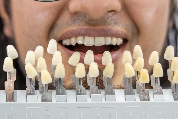 Guías organizadas de tonos dentales con etiquetas alfanuméricas que muestran varios colores de dientes