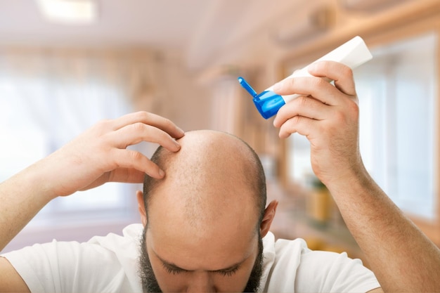 Haarausfall Kopfhaut Alopezie Hintergrund kahl