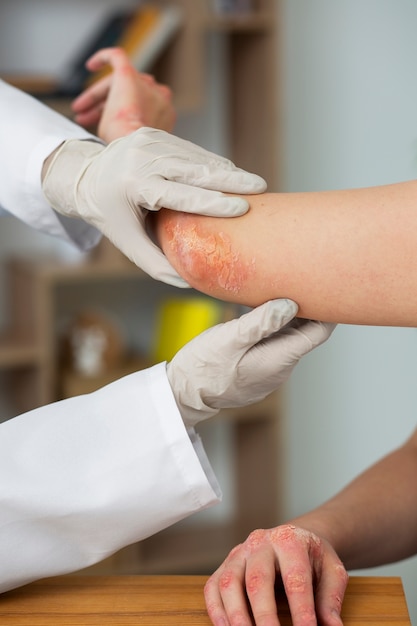 Hände eines Patienten, der an Psoriasis leidet