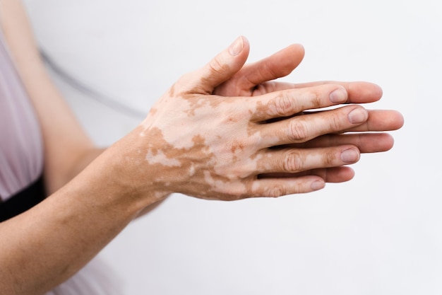 Hände mit Vitiligo-Hautpigmentierung auf weißem Hintergrund, Nahaufnahme Lebensstil mit saisonalen Hautkrankheiten