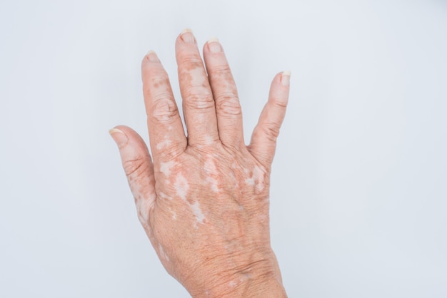 Hände mit Vitiligo Hautproblem