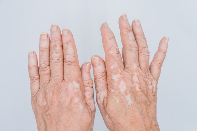 Hände mit Vitiligo Hautproblem