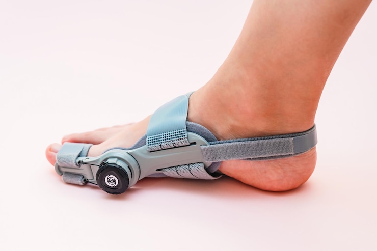 Foto hallux valgus aparelho ortopédico médico para o polegar com ajuste no pé feminino