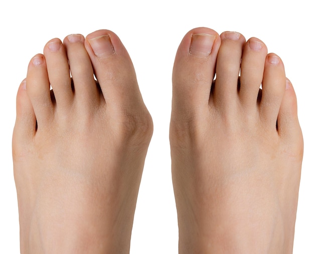 Hallux valgus vor und nach der Operation