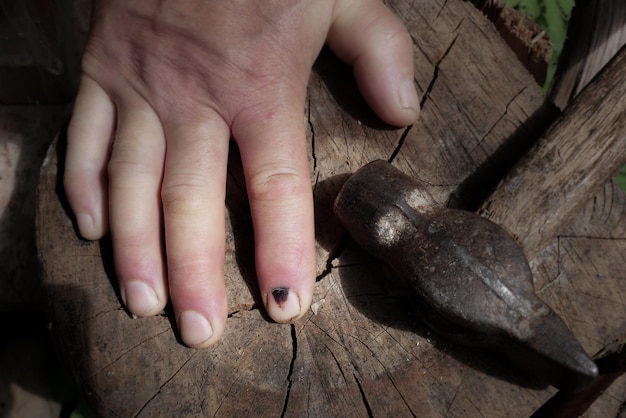 Foto hammer und menschlicher finger mit dunkelem verletzten nagel fingerverletzung schwarzes hämatom an den nägeln nach dem hammern gefährlicher job