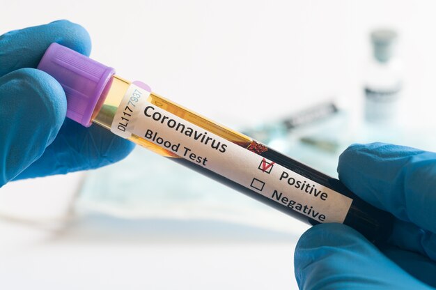 Hand hält Test Blutproben von Patienten auf Coronavirus