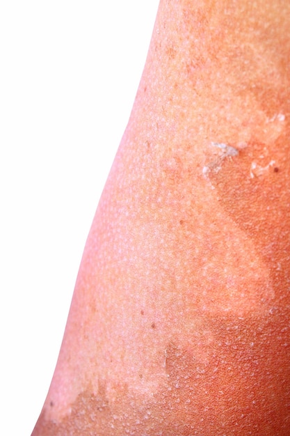 Haut, die nach dem Sonnenbaden auf dem Arm eines Mannes herumklettert, Spuren von Sonnenbrand auf dem Arm des Mannes Menschliche Haut nach dem Sonnebaden Konsequenz eines übermäßigen Sonnenbrennens