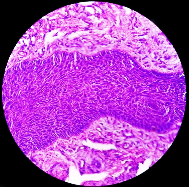 Hautbiopsie unter dem Mikroskop, die auf ein Basalzellkarzinom hindeutet, die häufigste Art von Hautkrebs