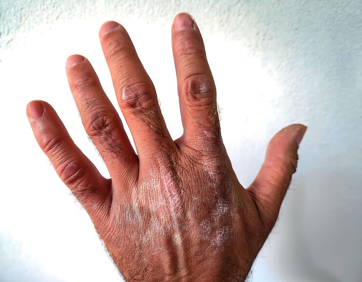 Foto hautkrankheit trockene haut kratzt die schuppige haut